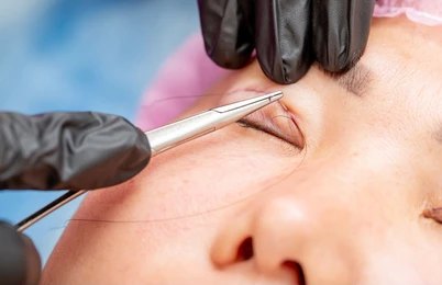 Brow Lift